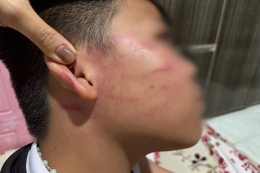 Nam sinh 9 tuổi nghi bị giáo viên dạy thêm đánh bầm mặt, ù tai
