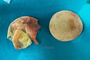 Người phụ nữ vỡ túi ngực không hay biết