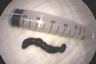 Bắt con đỉa dài 9cm ra khỏi thực quản