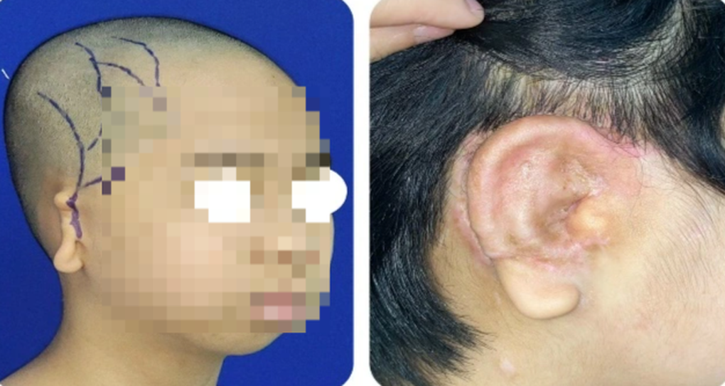 Đắp tai cho bé trai 5 tuổi mắc dị tật tai nhỏ - 2 Đắp tai cho bé trai 5 tuổi mắc dị tật tai nhỏ - 2