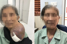 Giải thoát cụ bà khỏi khối u 3kg lủng lẳng trên mặt suốt 40 năm