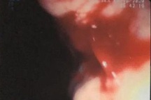 Cứu người đàn ông ung thư gan nguy kịch vì xuất huyết tiêu hóa