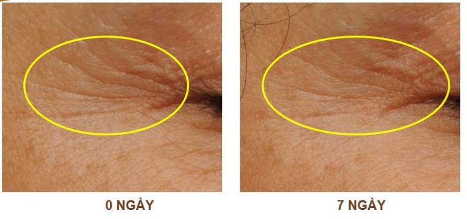 Chuyên gia Đại học Y Hà Nội giới thiệu công nghệ chống nhăn từ giải Nobel - 4 Chuyên gia Đại học Y Hà Nội giới thiệu công nghệ chống nhăn từ giải Nobel - 4