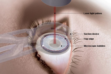 10 thắc mắc thường gặp về phẫu thuật lasik