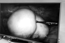 Bé gái 13 tuổi đau bụng âm ỉ vì khối u lớn ở buồng trứng