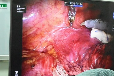 Robot làm nhiệm vụ phẫu thuật tại Chợ Rẫy