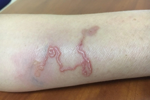 Chảy máu cam, ngứa mới biết ký sinh trùng từ chó đang "bơi" trong người