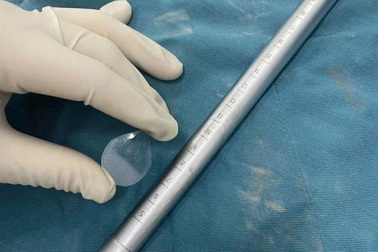 Miếng dị vật trong suốt nguy hiểm "ẩn" trong cổ họng bé trai