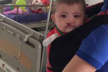 Phẫu thuật miễn phí hở môi, vòm miệng suốt 365 ngày