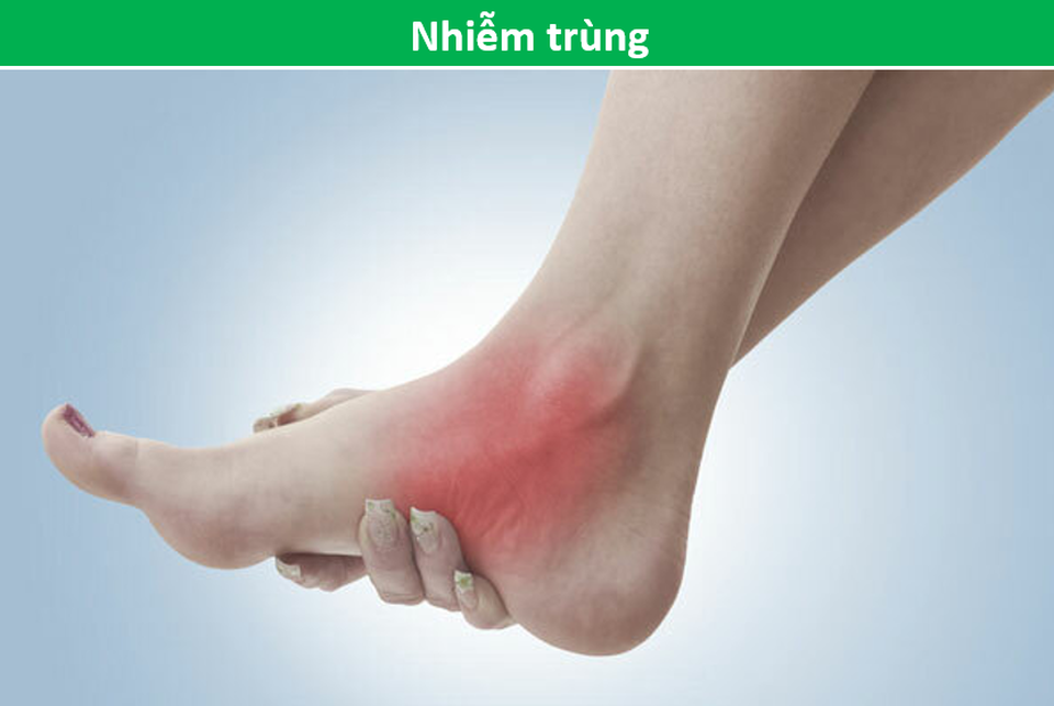 Bàn chân đột nhiên bị sưng, phù không rõ nguyên do cảnh báo bệnh gì? - 4 Bàn chân đột nhiên bị sưng, phù không rõ nguyên do cảnh báo bệnh gì? - 4