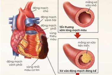 Rối loạn mỡ máu - sát thủ âm thầm gây nhồi máu cơ tim