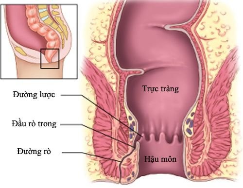 Rò hậu môn