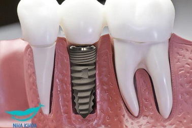 Cấy ghép Implant Surface Slactive 5D - Trọn vẹn một nụ cười!