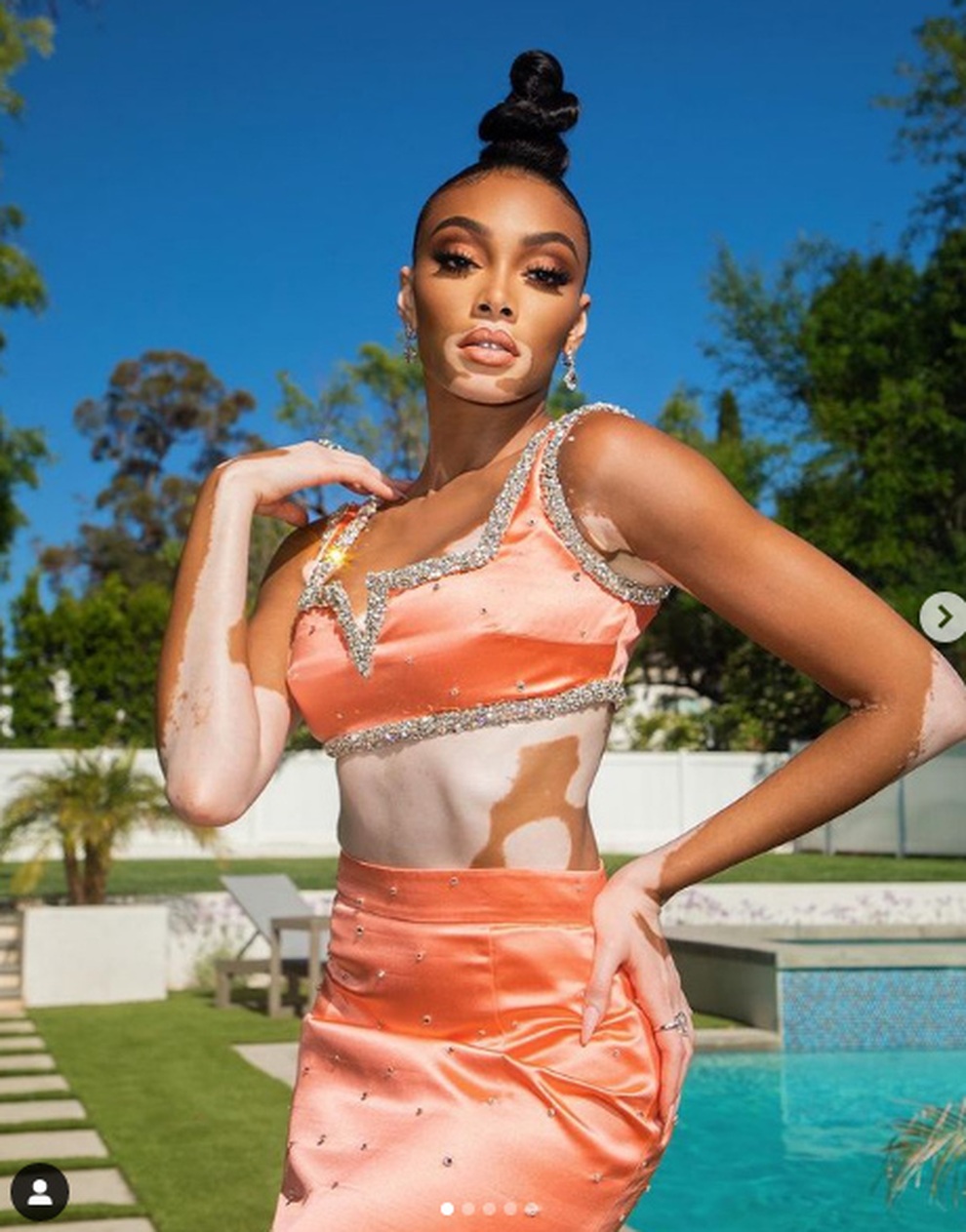 Siêu mẫu bạch biến Winnie Harlow gây choáng với váy xẻ bất tận - 8 Siêu mẫu bạch biến Winnie Harlow gây choáng với váy xẻ bất tận - 8