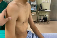 Nam sinh lõm sâu ngực vì loại bệnh lý dễ bị bỏ qua lúc nhỏ