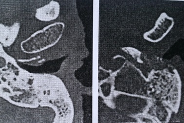 TPHCM: Hàng chục người bị hủy xương tai vì bệnh ác tính tỷ lệ tử vong cao