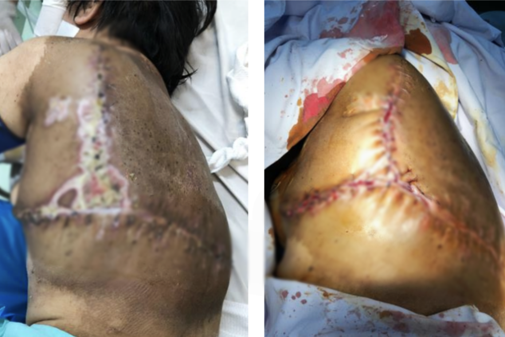 Người phụ nữ ở TPHCM mang mai rùa khổng lồ trên lưng vì căn bệnh hiếm - 3 Người phụ nữ ở TPHCM mang mai rùa khổng lồ trên lưng vì căn bệnh hiếm - 3
