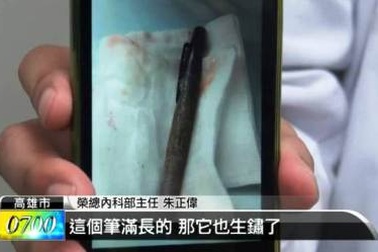 Bút nằm trong dạ dạy suốt 6 tháng mà không biết