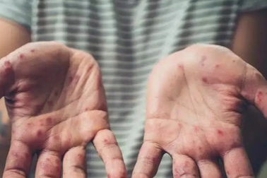 Việc xuất hiện thêm ca đậu mùa khỉ là có thể xảy ra