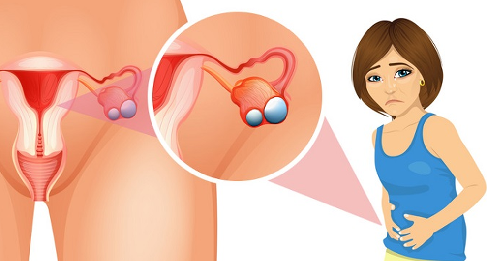 Dấu hiệu cảnh báo u nang buồng trứng và cách cải thiện từ thảo dược - 3 Dấu hiệu cảnh báo u nang buồng trứng và cách cải thiện từ thảo dược - 3