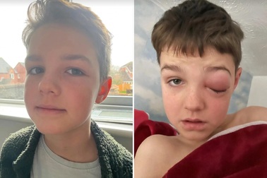 Mẹ lo con trai 9 tuổi bị mù sau khi mắc Covid-19