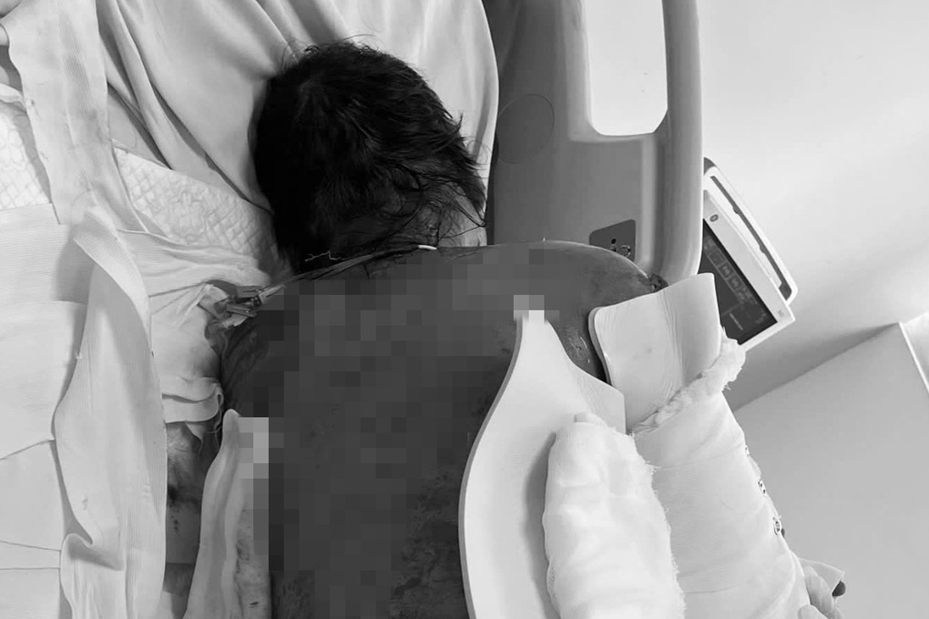Hội chứng hiểm khiến người phụ nữ bong tróc da 92% sau khi dùng kháng sinh - 1 Hội chứng hiểm khiến người phụ nữ bong tróc da 92% sau khi dùng kháng sinh