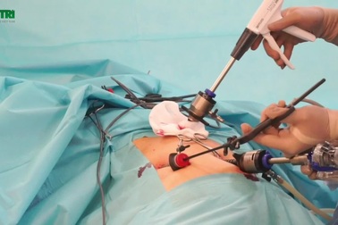 Bác sĩ nội soi cắt túi mật chứa đầy sỏi cho bệnh nhân