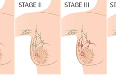 Các giai đoạn phát triển ung thư vú