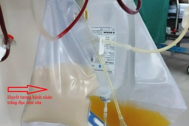 Bệnh nhân bị viêm tụy cấp, huyết tương trắng như sữa