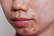 Chuyên gia chia sẻ cách chăm da mụn chuẩn khoa học