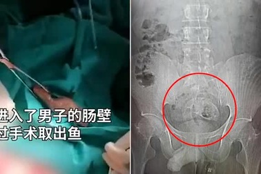 Phát hiện nguyên con cá rô phi trong bụng