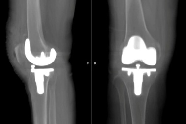 Tập đi sau 6 tiếng mổ thay khớp gối nhờ ứng dụng công nghệ 3D