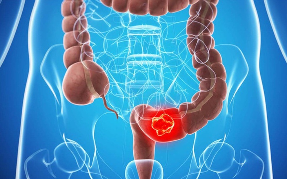 Mối liên quan giữa polyp và ung thư đại trực tràng - 1 Mối liên quan giữa polyp và ung thư đại trực tràng - 1