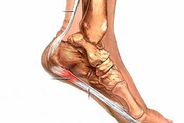 Trị chứng viêm gân mặt bàn chân