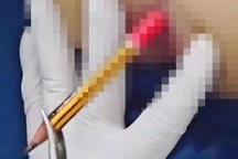 TPHCM: Con trai 5 tuổi nhét bút chì vào hậu môn, mẹ tá hỏa đưa đi cấp cứu