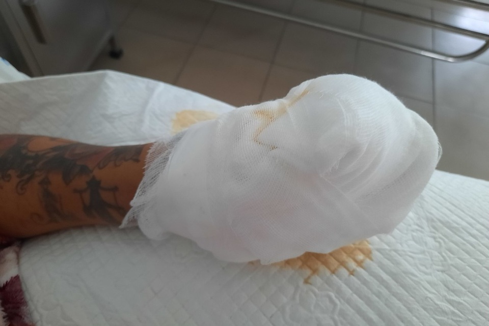 Nát bàn tay, hỏng mắt vì chơi pháo ngày Tết - 2 Nát bàn tay, hỏng mắt vì chơi pháo ngày Tết - 2