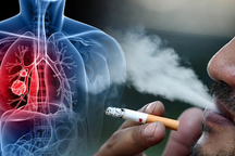 75% người mắc bệnh ung thư nguy hiểm hàng đầu ở Việt Nam phát hiện muộn