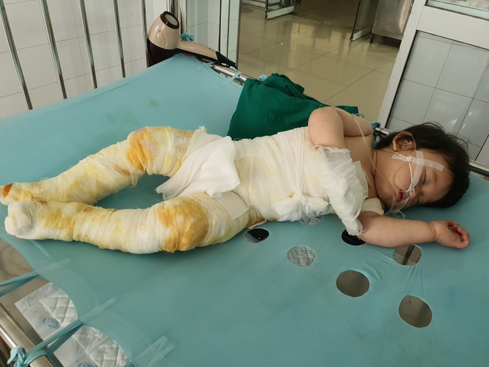 Đau nhói lòng cảnh bé gái 14 tháng tuổi ngã vào nồi nước sôi nguy kịch - 3 Đau nhói lòng cảnh bé gái 14 tháng tuổi ngã vào nồi nước sôi nguy kịch - 3