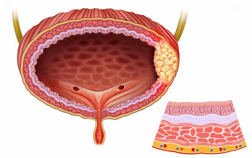 Bí tiểu, khó tiểu - dấu hiệu sớm cảnh báo ung thư bàng quang - 1