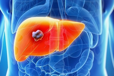 Bảo vệ lá gan trước sự tàn phá của rượu bia