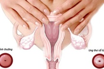 Thuốc lá có gây ung thư cổ tử cung không?