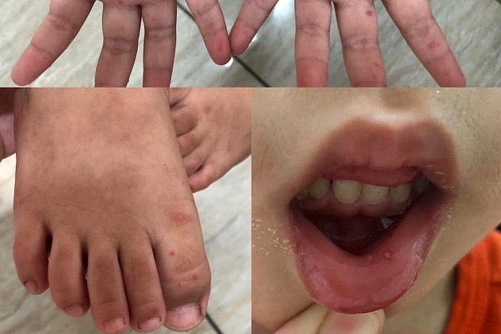 Số trẻ mắc tay chân miệng tại Hà Nội tiếp tục tăng - 1