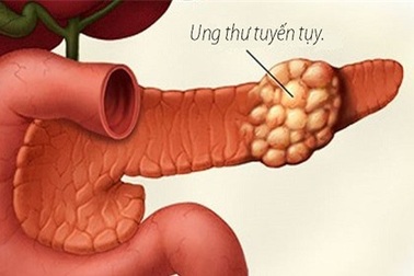 Cần làm xét nghiệm gì để chẩn đoán ung thư tụy?