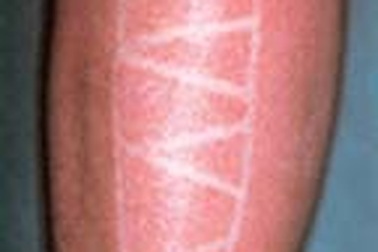 Dùng thuốc trong bệnh dị ứng 