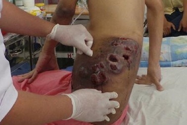 2 bệnh nhân “tiêu” hàng chục tỷ đồng quỹ Bảo hiểm Y tế