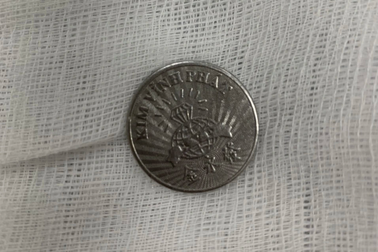 Ngậm đồng xu chơi, bé gái 10 tuổi vô tình nuốt vào thực quản