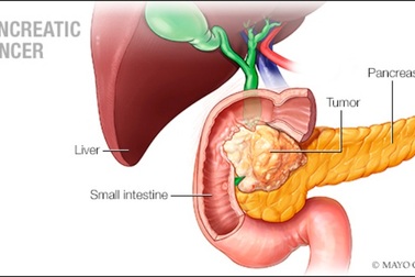 Khi nào đau bụng là dấu hiệu cảnh báo ung thư tuyến tụy