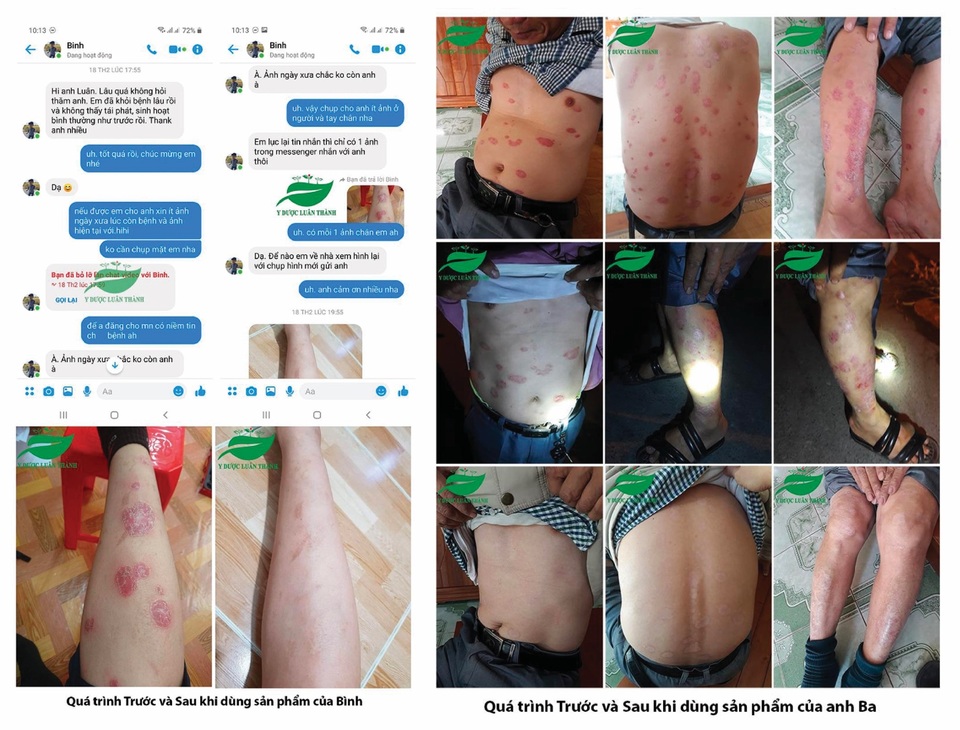 Tìm ra giải pháp giúp hỗ trợ cho người bị vảy nến, viêm da cơ địa - 5 Tìm ra giải pháp giúp hỗ trợ cho người bị vảy nến, viêm da cơ địa - 5