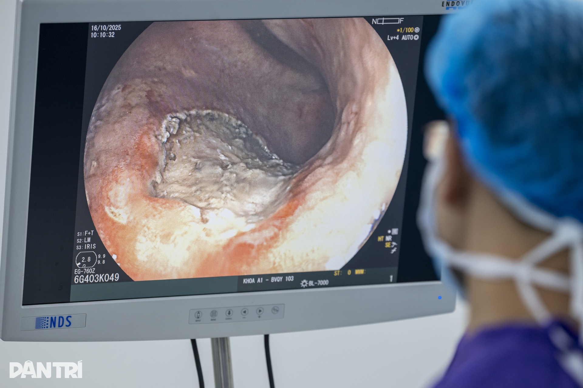 Xem bác sĩ thâm nhập dạ dày truy vết ung thư - 9 Xem bác sĩ thâm nhập dạ dày truy vết ung thư - 9