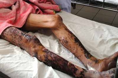 10 người tử vong do mắc bệnh liên cầu lợn